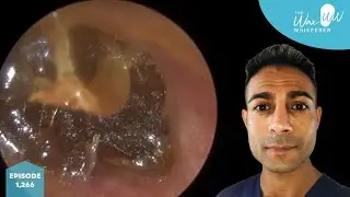 1,266 - Wet Genetic Type Ear Wax Removal