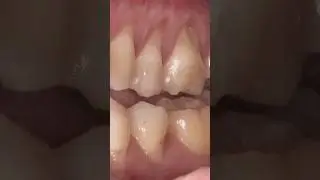 Can You Regrow Your Gums Naturally?