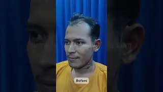 Solusi kebotakan, bisa di Hair4all Indonesia