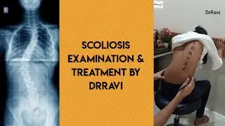 Scoliosis Examination & Treatment By DrRavi