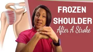 Frozen Shoulder: #1 Cause of post stroke shoulder pain