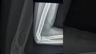 Avian spur / Supracondylar spur of humerus - Anatomical variant
