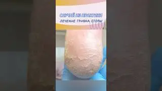 Лечение грибка стопы #грибок #лечениегрибка #дерматология #грибокногтей #подология #подолог #микоз