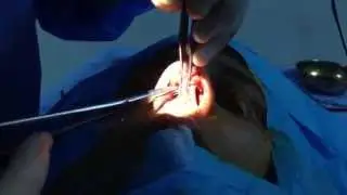 ESTETİK BURUN AMELİYATI