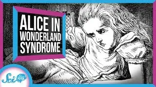Alice in Wonderland Syndrome