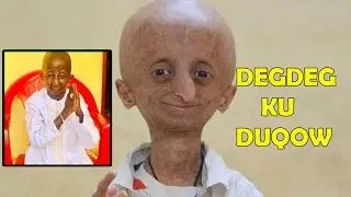 Cudurkka Dagdag ku duqoobida (progeria)