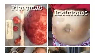 Mi operación de fibromas  o miomas