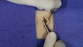Set-Back Buried Dermal Suture Technique