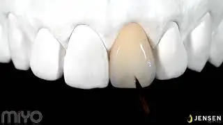 MiYO Esthetic Finishing System Structure Technique