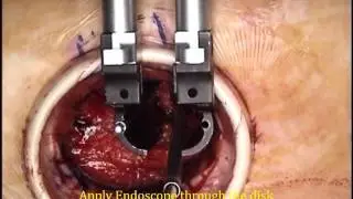 OLIF assisted with spinal endoscopy_Chapter 26