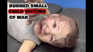 BURNED SMALL CHILD VICTIMS OF WAR / TERBAKAR ANAK KECIL KORBAN PERANG