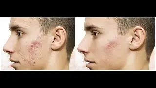 Face Spot Remove In Photoshop II Photoshop Editing