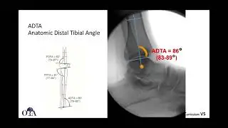 Pilon fractures - 1 of 2 - OTA CCv5