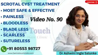 Treatment of Scrotal Cyst with low sperm count (अंडकोष पर गांठ) No. 90
