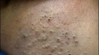 Blackheads Removal & Pimple Treatment | Korean Skincare Routine & Deep Cleansing