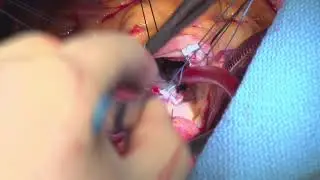 Aortic Valve Replacement  Step by Step (Step 2 of 7)