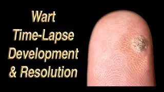 Wart Development & Resolution Time Lapse