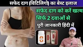 Treatment  for vitiligo/leucoderma/सफेद दाग (विटिलिगो) को करें ठीक