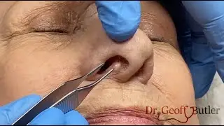De-roofing of nasal cyst
