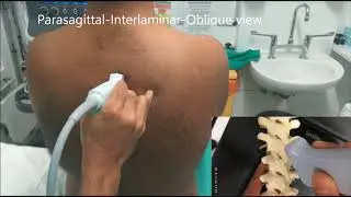 Realtime Ultrasound guided Thoracic epidural insertion