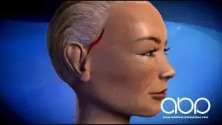 Face Lift