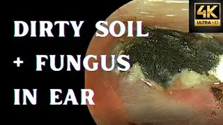 Dirty Soil + Fungus  In Ear