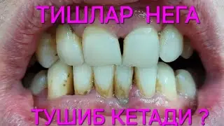 ТИШЛАР НЕГА ТУШИБ КЕТАДИ? МОСКВА СТОМ ШАВКАТ +79636579707 ВАТСАП ТЕЛЕГРАМ
