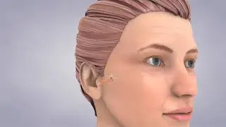 Types of Hearing Loss