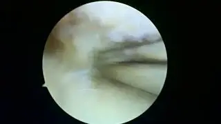 Do you have a meniscus tear we can repair?  Knee pain? Bucket Handle tear? 6 8 23 ME