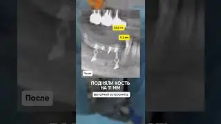 Подняли кость на 11 мм - костная пластика