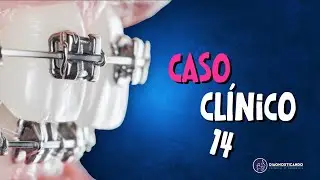 Caso Clínico 14- Mas o paciente é classe I molar; porquê cirurgia?