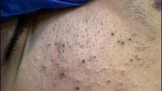 Deep Facial Cleansing Techniques for Acne | Whitehead and Blackheads Solutions