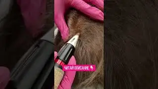 Залысина на голове что делать? Частичное облысение. Очаговая алопеция