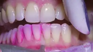 Guided Biofilm Therapy (GBT) at Burneston Dental
