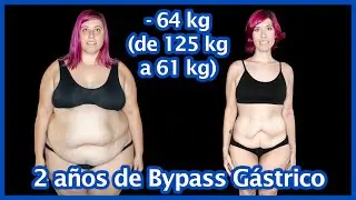 Bypass Gástrico - 2 Años Comparativa de Fotos (-64 kg Perdidos!)