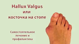 Hallux Valgus
