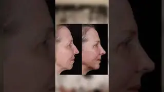 Rhinoplasty for Older Folk with Sam & Meg