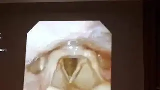 The Larynx