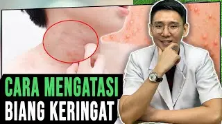 Cara Mengatasi Penyakit Kulit Biang Keringat
