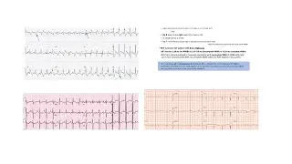 ECG QRS abnormalities- Part 2