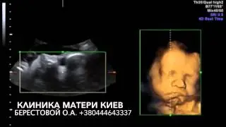 УНИКАЛЬНОЕ НА УЗИ 4D  Спокойствие или улыбки в ходе исследования меняются на "злость" или "обиду"