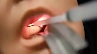 Peritonsillar Abscess Drainage