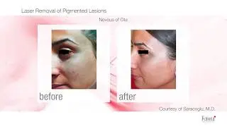 Lesiones pigmentarias | tto con láser Fotona StarWalker MaQX®