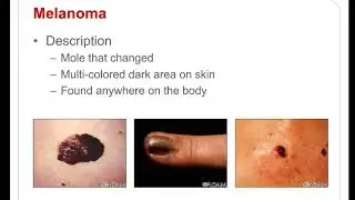 Food, Nutrition, and Wellness with Dr. Dan Remley  Short Video Carcinomas