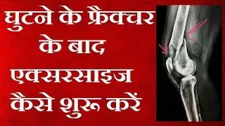 Exercise for KNEE after FRACTURE or injury