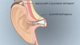 Заушные слуховые аппараты