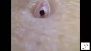 Удаление большой черной точки