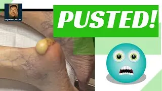 Large Heel Abscess Drained