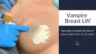 Naturally Increase Cup Size with the Vampire Breast Lift®