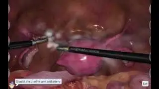 LapSim Hysterectomy:  Uterine Artery Dissection